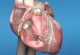 Abbott Launches Dual Chamber Leadless Pacemaker System