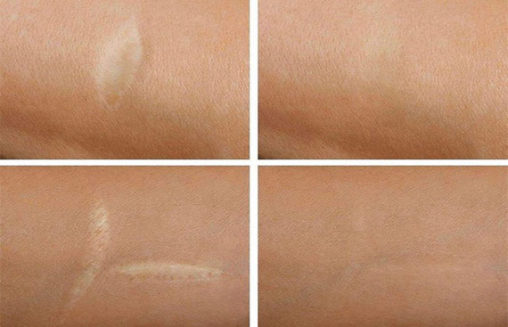 Scar and Stretch Mark Tattoo Camouflage- All You Need To Know