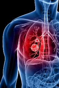 Faster cancer prognosis, courtesy IISc and Apple