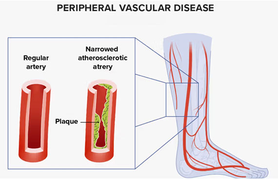What is Peripheral Vascular Disease? Symptoms and Causes Explained