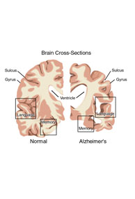 5 Signs To Know If You Have Alzheimer\'s Disease