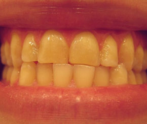 5 Things to Avoid for A Healthy Teeth